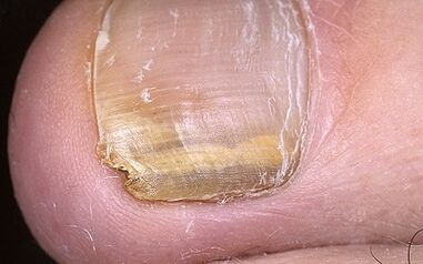 manifestations du champignon dans le pouce de la jambe