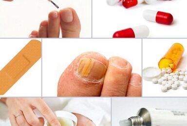 Comment traiter les champignons à ongles