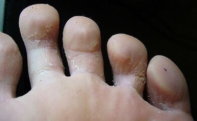 Comment voyez-vous le champignon sur vos jambes et comment le traiter