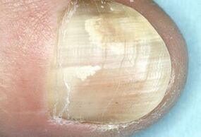 dommages à la plaque à ongles dus à une infection fongique