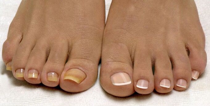 Champignon des ongles des pieds.