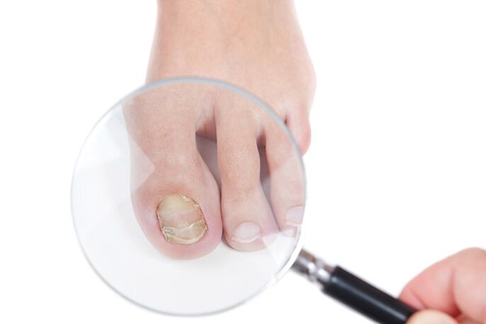 Un ongle atteint de champignon sous une loupe. 