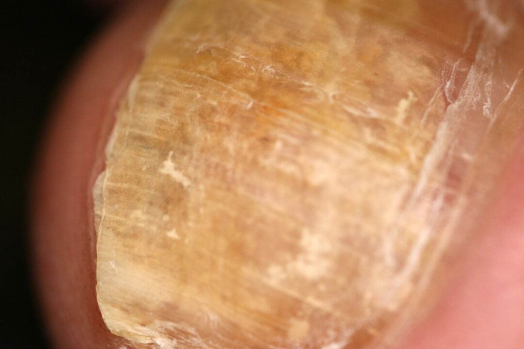 Apparition d'une plaque à ongles affectée par des champignons. 